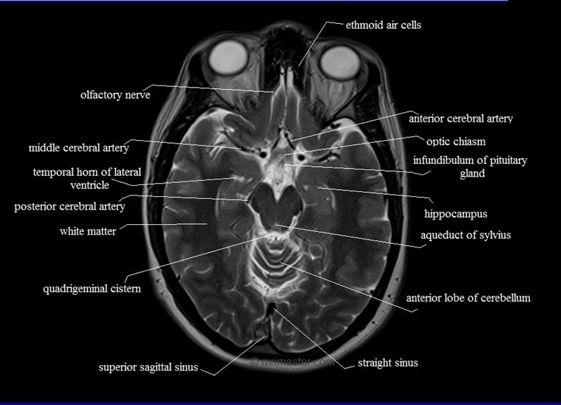 cross-sectional-anatomy-mri-brain-11