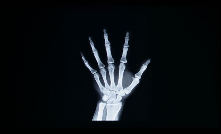 An X-Ray as projected by the Epson PowerLite 1785W operating in DICOM SIM