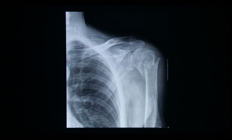 An X-Ray as projected by the Epson PowerLite 1785W operating in DICOM SIM